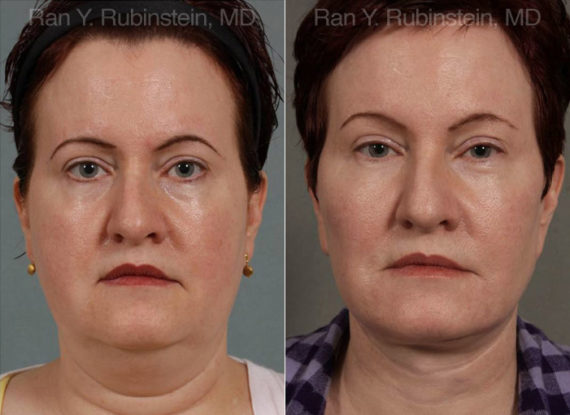 Face lift & Neck lift Before and After Photos in Montvale, NJ, Patient 12636