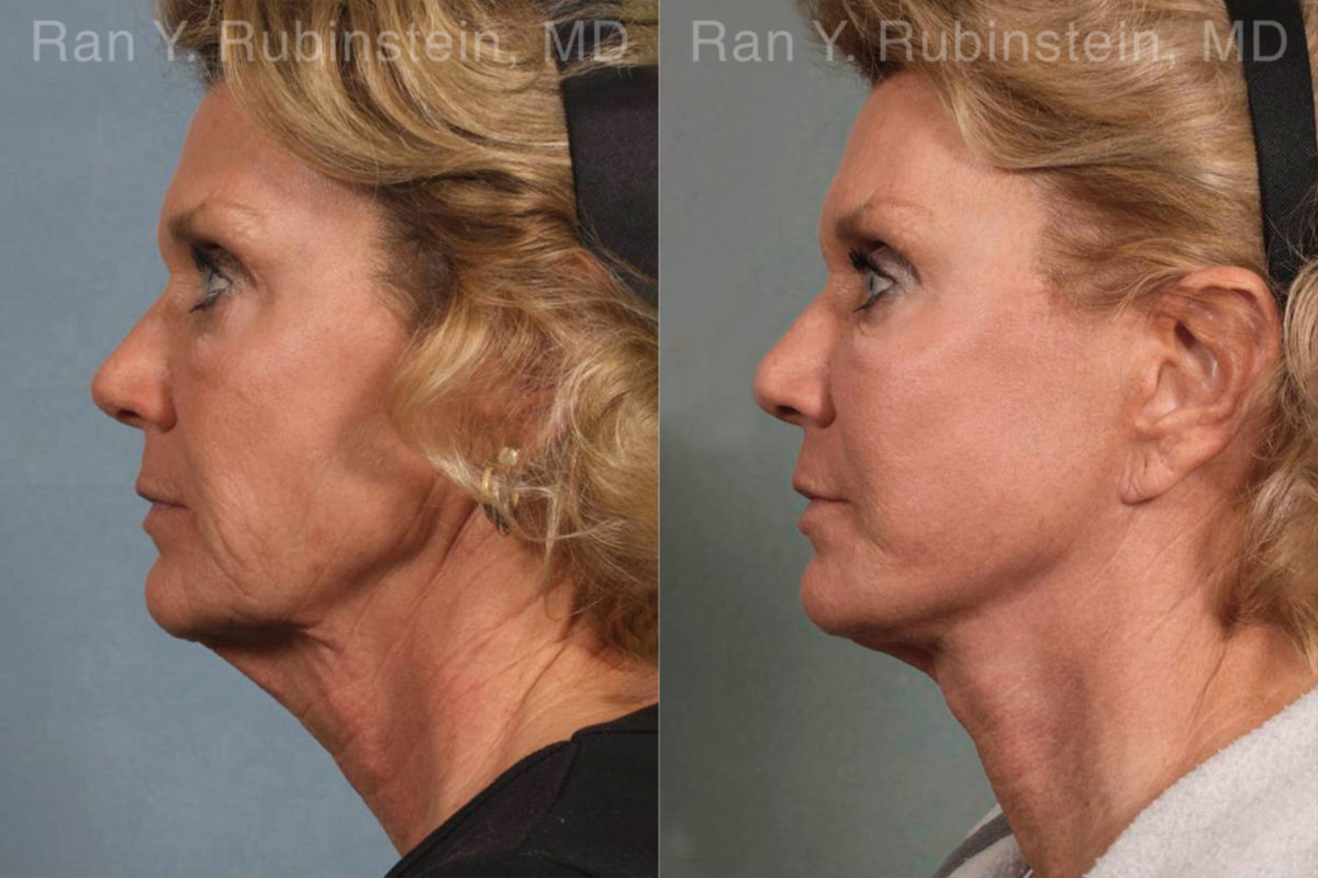 Face lift & Neck lift Before and After Photos in Montvale, NJ, Patient 12648