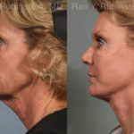 Face lift & Neck lift Before and After Photos in Montvale, NJ, Patient 12648