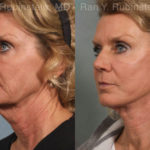 Face lift & Neck lift Before and After Photos in Montvale, NJ, Patient 12648