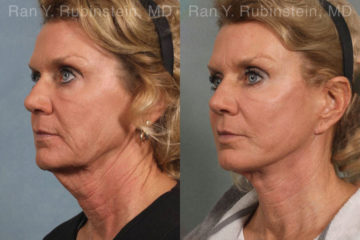 Face lift & Neck lift Before and After Photos in Montvale, NJ, Patient 12648