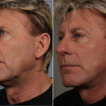 Face lift & Neck lift Before and After Photos in Montvale, NJ, Patient 12668