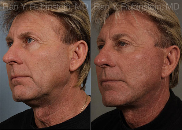 Face lift & Neck lift Before and After Photos in Montvale, NJ, Patient 12668