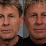 Face lift & Neck lift Before and After Photos in Montvale, NJ, Patient 12668