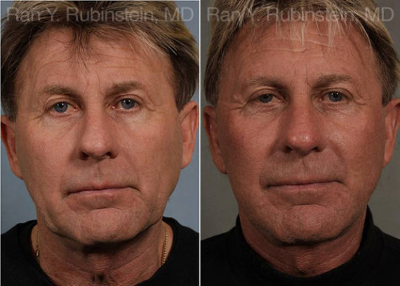 Face lift & Neck lift Before and After Photos in Montvale, NJ, Patient 12668