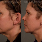 Face lift & Neck lift Before and After Photos in Montvale, NJ, Patient 12681