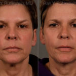Face lift & Neck lift Before and After Photos in Montvale, NJ, Patient 12681