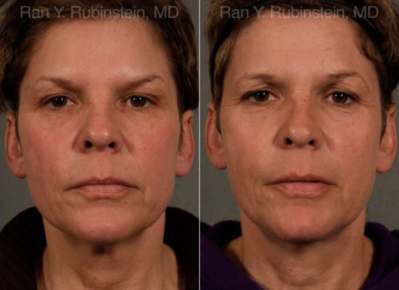 Face lift & Neck lift Before and After Photos in Montvale, NJ, Patient 12681