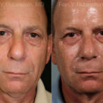 Sculptra Face Before and After Photos in Montvale, NJ, Patient 12776
