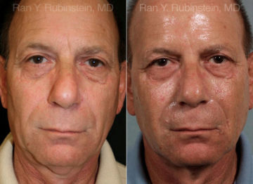 Sculptra Face Before and After Photos in Montvale, NJ, Patient 12776