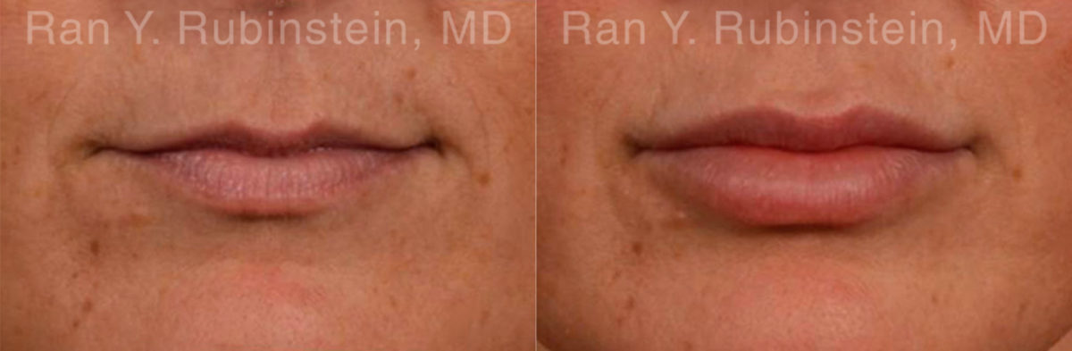 Lip Fillers Before and After Photos in Montvale, NJ, Patient 12785