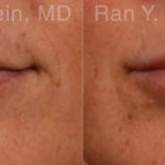 Lip Fillers Before and After Photos in Montvale, NJ, Patient 12785