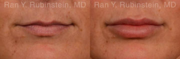 Lip Fillers Before and After Photos in Montvale, NJ, Patient 12785
