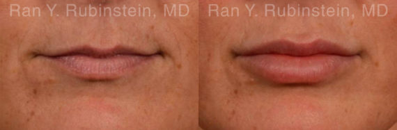 Lip Fillers Before and After Photos in Montvale, NJ, Patient 12785
