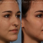Rhinoplasty Before and After Photos in Montvale, NJ, Patient 13142