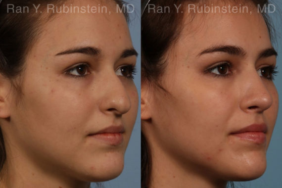 Rhinoplasty Before and After Photos in Montvale, NJ, Patient 13142