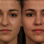 Rhinoplasty Before and After Photos in Montvale, NJ, Patient 13142