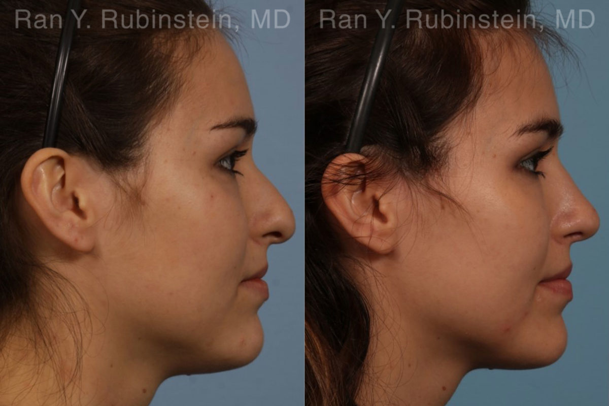 Rhinoplasty Before and After Photos in Montvale, NJ, Patient 13142