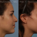 Rhinoplasty Before and After Photos in Montvale, NJ, Patient 13142