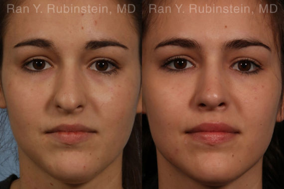 Rhinoplasty Before and After Photos in Montvale, NJ, Patient 13142