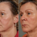 Laser Lift Precision Tx Before and After Photos in Montvale, NJ, Patient 13265