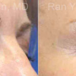 Microneedling RF Before and After Photos in Montvale, NJ, Patient 16590