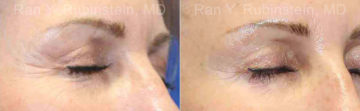 Microneedling RF Before and After Photos in Montvale, NJ, Patient 16590