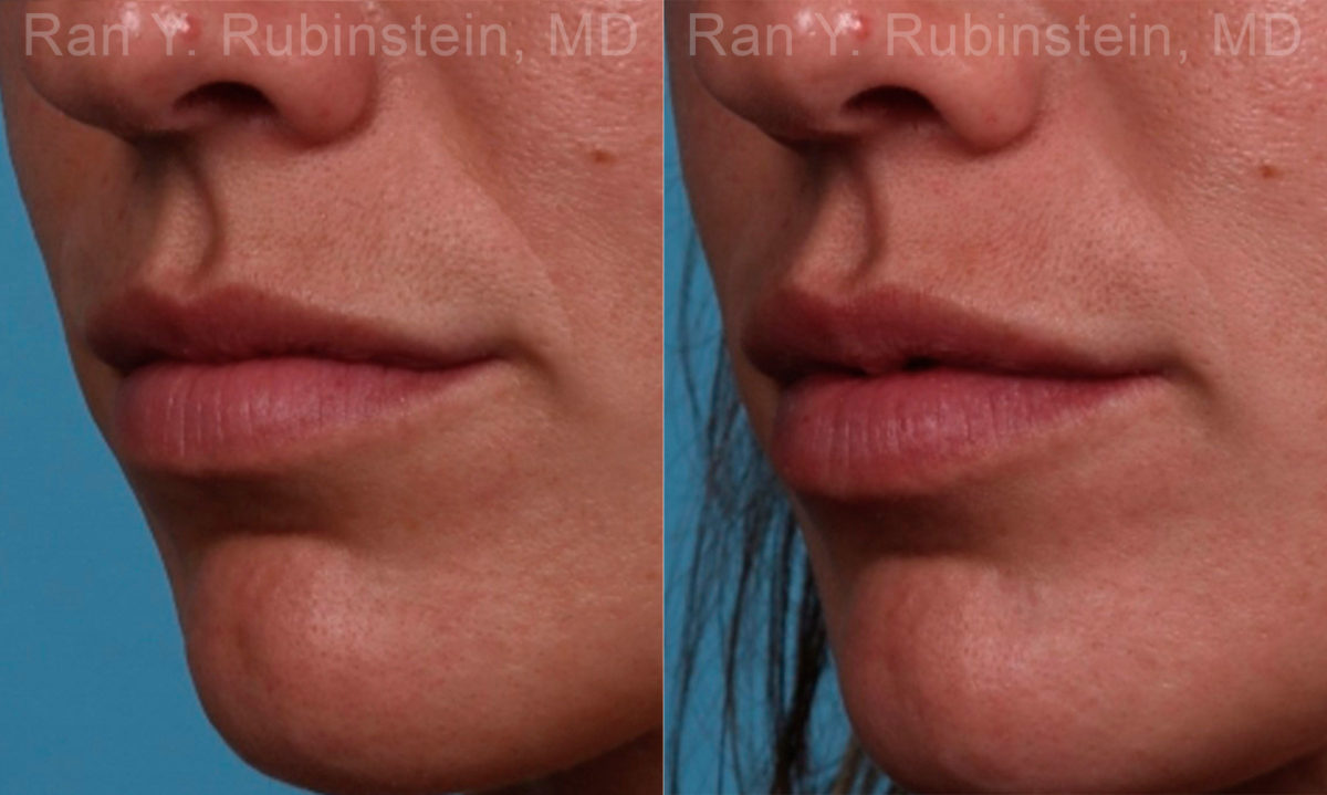Lip Fillers Before and After Photos in Montvale, NJ, Patient 17216