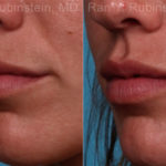 Lip Fillers Before and After Photos in Montvale, NJ, Patient 17216