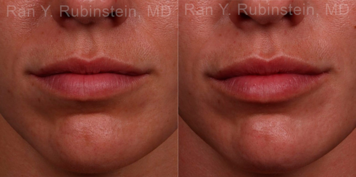 Lip Fillers Before and After Photos in Montvale, NJ, Patient 17216