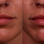 Lip Fillers Before and After Photos in Montvale, NJ, Patient 17216