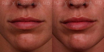 Lip Fillers Before and After Photos in Montvale, NJ, Patient 17216