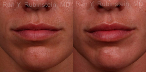 Lip Fillers Before and After Photos in Montvale, NJ, Patient 17216