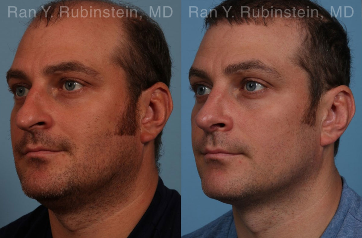 Rhinoplasty Before and After Photos in Montvale, NJ, Patient 17247