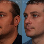Rhinoplasty Before and After Photos in Montvale, NJ, Patient 17247