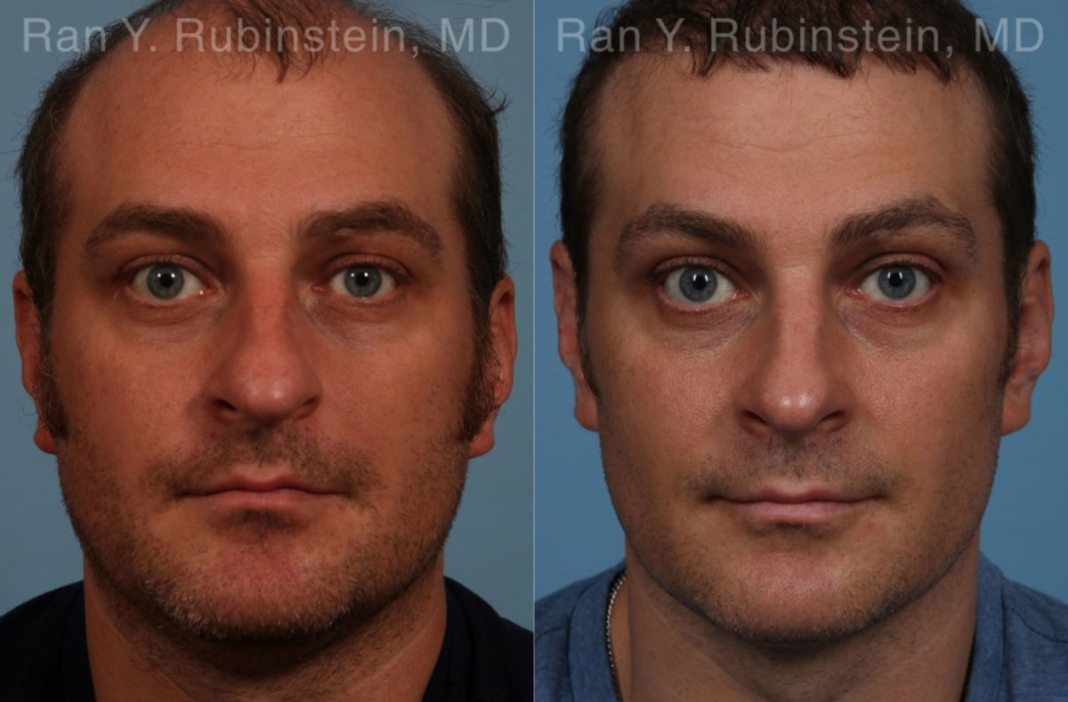 Rhinoplasty Before and After Photos in Montvale, NJ, Patient 17247