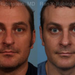 Rhinoplasty Before and After Photos in Montvale, NJ, Patient 17247
