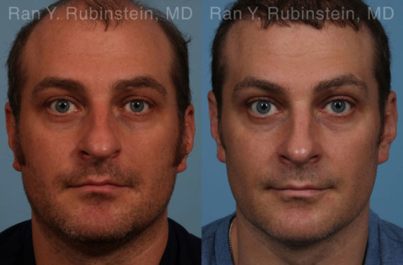 Rhinoplasty Before and After Photos in Montvale, NJ, Patient 17247