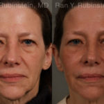 Dermal Fillers Before and After Photos in Montvale, NJ, Patient 17263