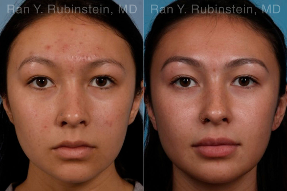 Laser Treatments Before and After Photos in Montvale, NJ, Patient 17406