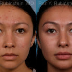 Laser Treatments Before and After Photos in Montvale, NJ, Patient 17406