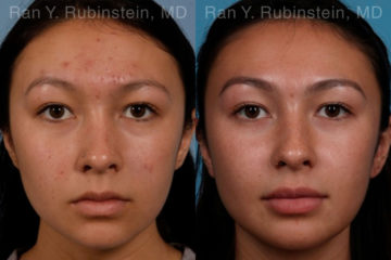 Laser Treatments Before and After Photos in Montvale, NJ, Patient 17406