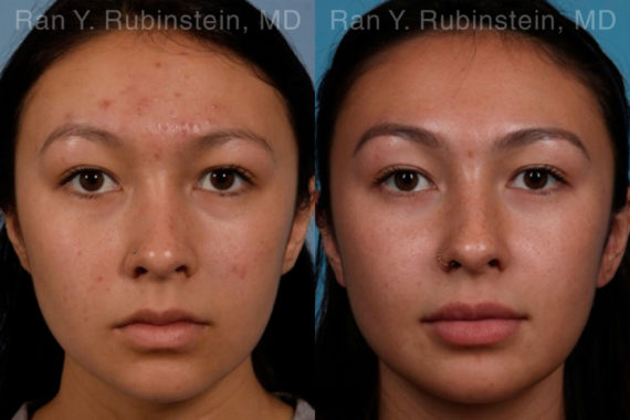 Laser Treatments Before and After Photos in Montvale, NJ, Patient 17406