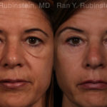 Eyelid Surgery Before and After Photos in Montvale, NJ, Patient 17657