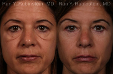 Eyelid Surgery Before and After Photos in Montvale, NJ, Patient 17657
