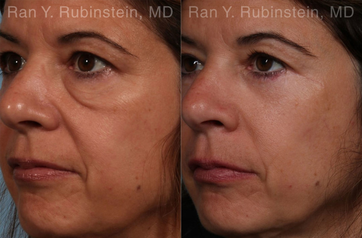 Eyelid Surgery Before and After Photos in Montvale, NJ, Patient 17657