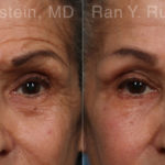 Botox Before and After Photos in Montvale, NJ, Patient 17907