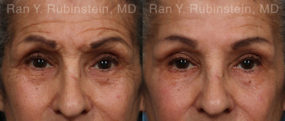 Botox Before and After Photos in Montvale, NJ, Patient 17907
