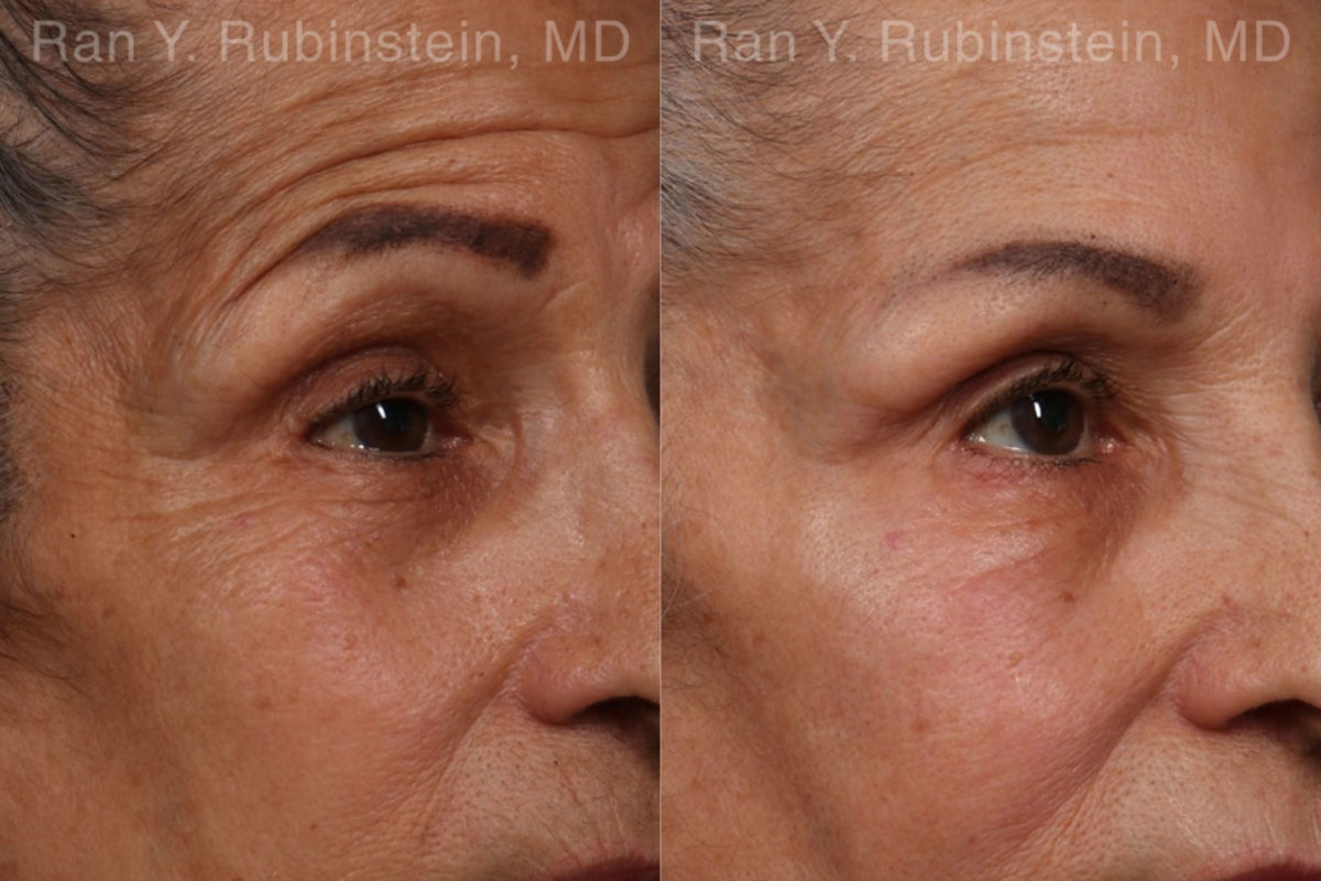 Botox Before and After Photos in Montvale, NJ, Patient 17907
