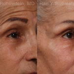 Botox Before and After Photos in Montvale, NJ, Patient 17907